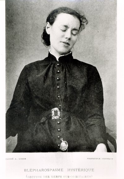 Blefaroespasmo involuntário, de &39;New Iconography of Salpetriere&39; pelo professor Jean Martin Charcot (1825-93) publicado em Paris, 1889 de Albert Londe